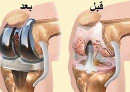 جراحی مفصل