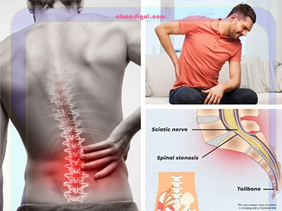 تنگی کانال نخاعی، آرتروز و اضافه وزن از دلایل اصلی ایجاد این درد هستند.