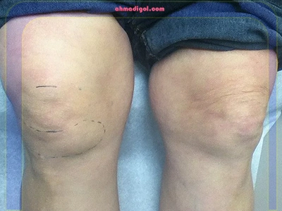 التهاب مفصل زانو