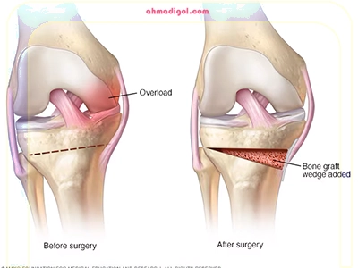 آرتروز زانو