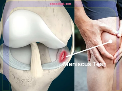 پارگی منیسک